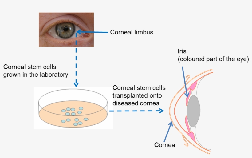 Diagram On Repairing The Cornea - Stem Cell In Eye, transparent png download