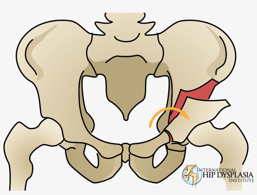 Pao2 - Periacetabular Osteotomy, transparent png download