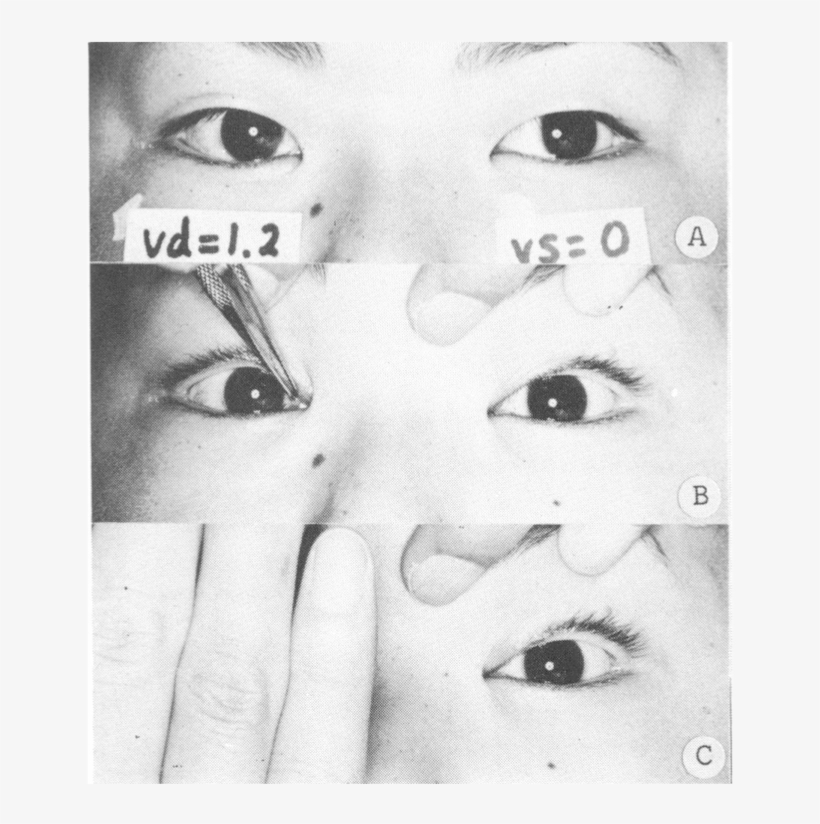 Magician Forceps Phenomenon, transparent png download