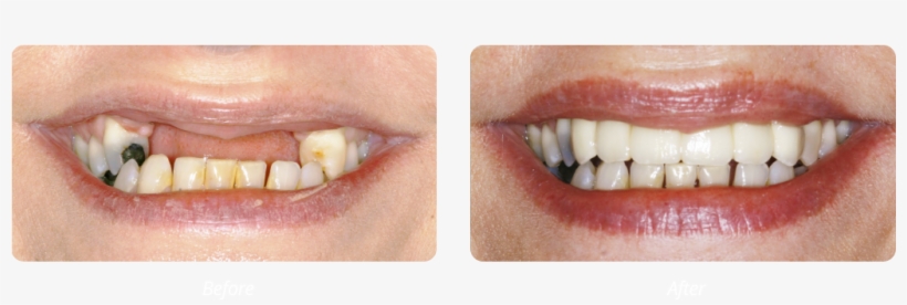 Dental Implants - Lip Gloss, transparent png download
