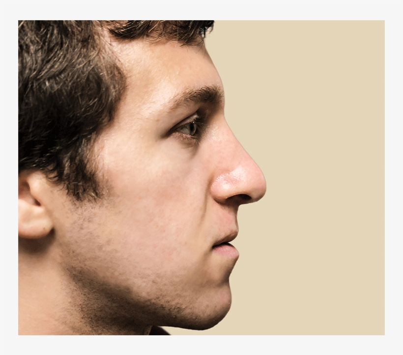 0005 Josh Katz After Edit - Surgery, transparent png download