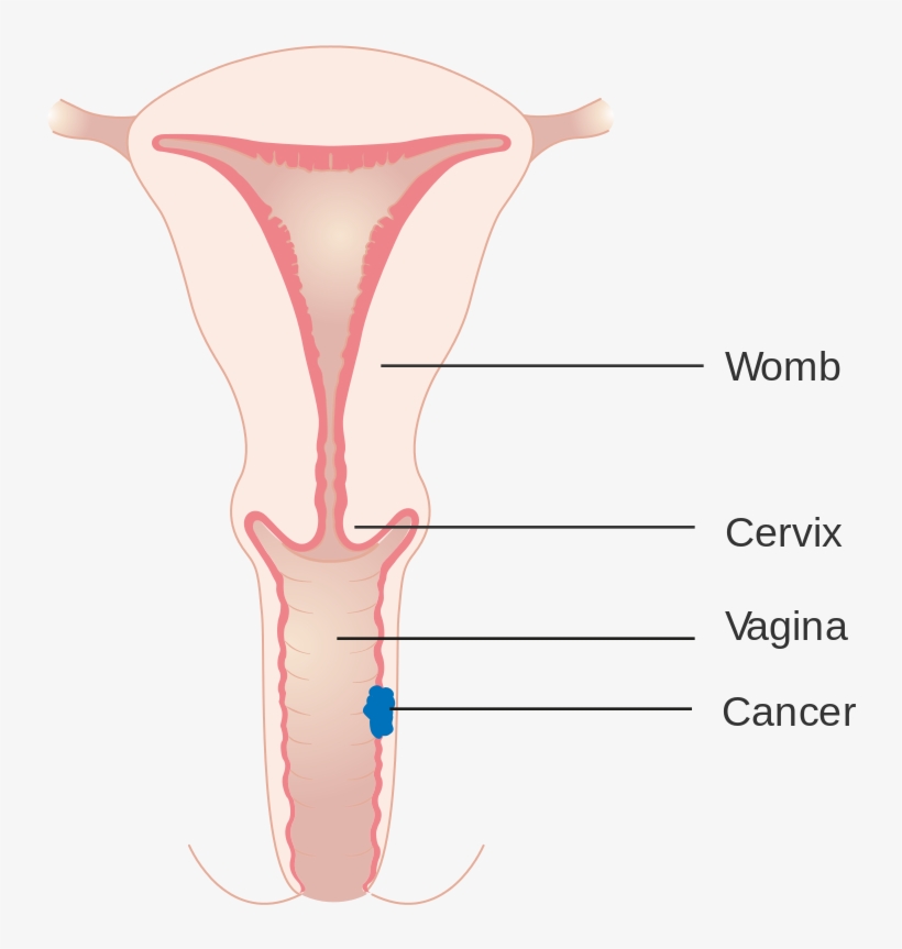 Open - سرطان المهبل, transparent png download