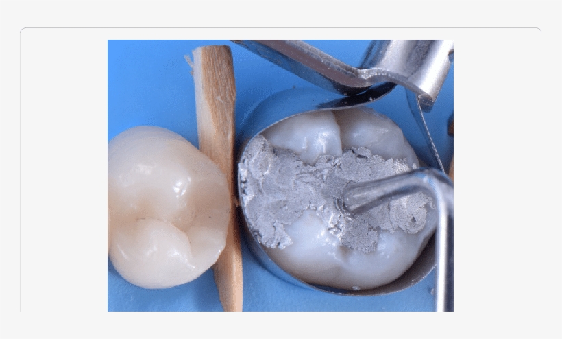 Manual Condensation Using Ward Condensers From 1 To - Manual Condensation Of Amalgam, transparent png download