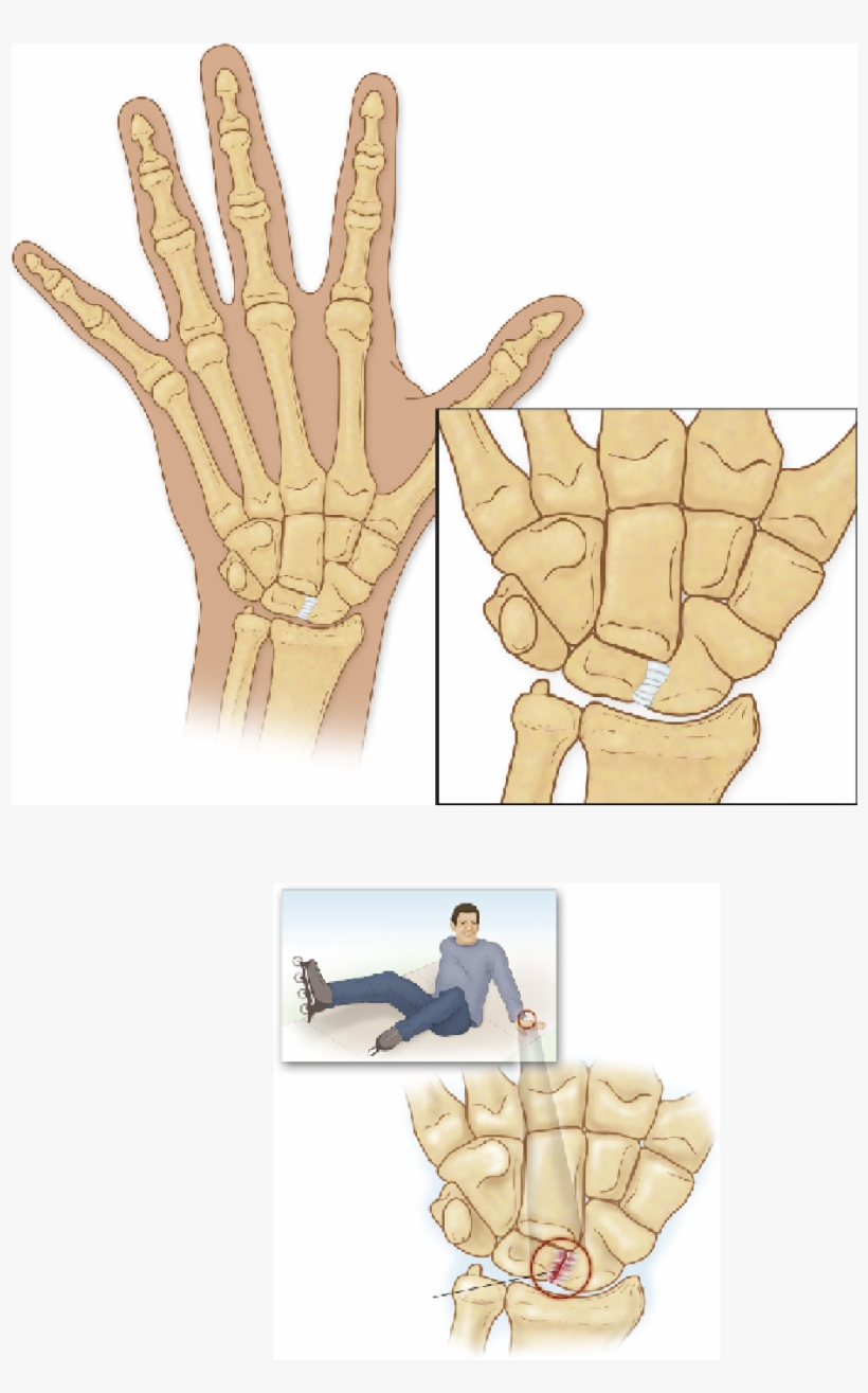 Scapholunate Ligament Tear Syndrome - Scapholunate Ligament Tear Symptoms, transparent png download