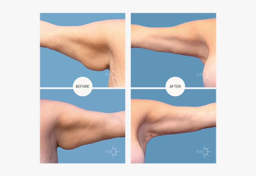 Brachioplasty - Brachioplastie, transparent png download