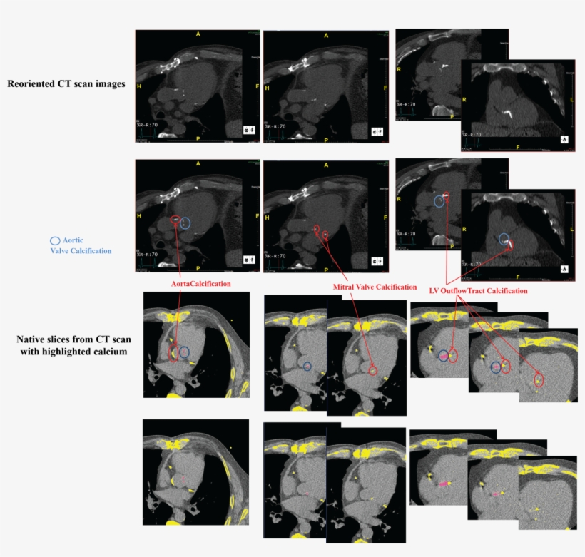 In Natural Ct Images , Calcium Appears As White Spots - Car Seat, transparent png download