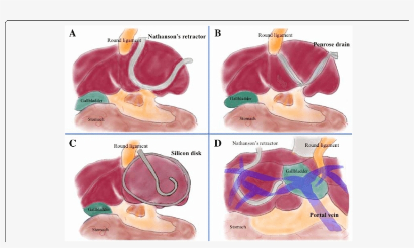 Methods Of Retracting The Left Liver Lobe, transparent png download
