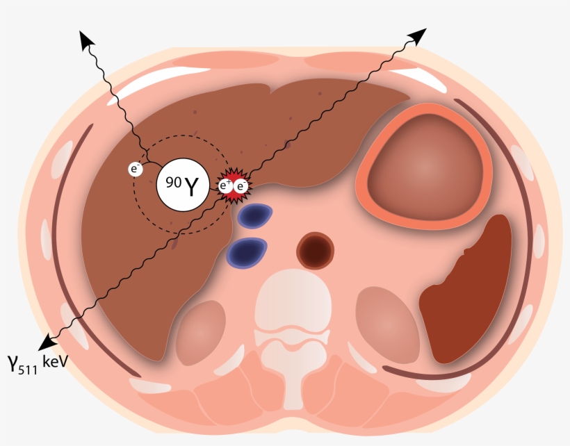 Radioembolization - Radioembolization Y90, transparent png download