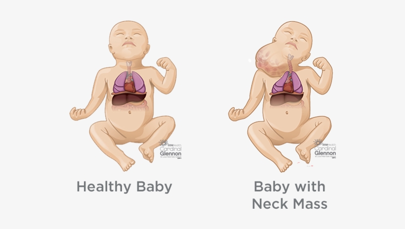 Fetal Neck Masses - Fetal Teratoma Neck, transparent png download
