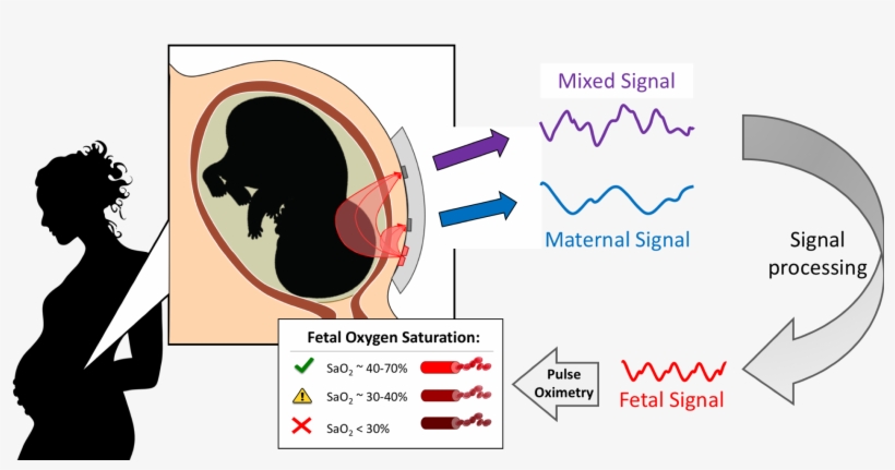 We Are Developing A Non-invasive, Transabdominal Fetal - Diagram, transparent png download