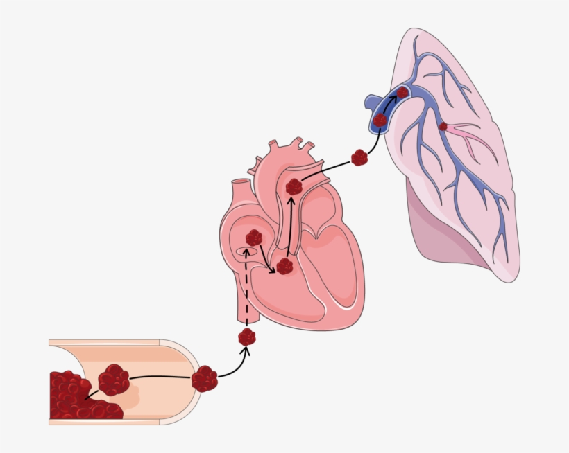 Pulmonary Embolism, transparent png download