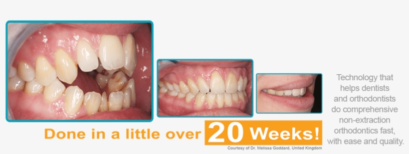 The Decision To Get Braces Can Be Scary One, transparent png download