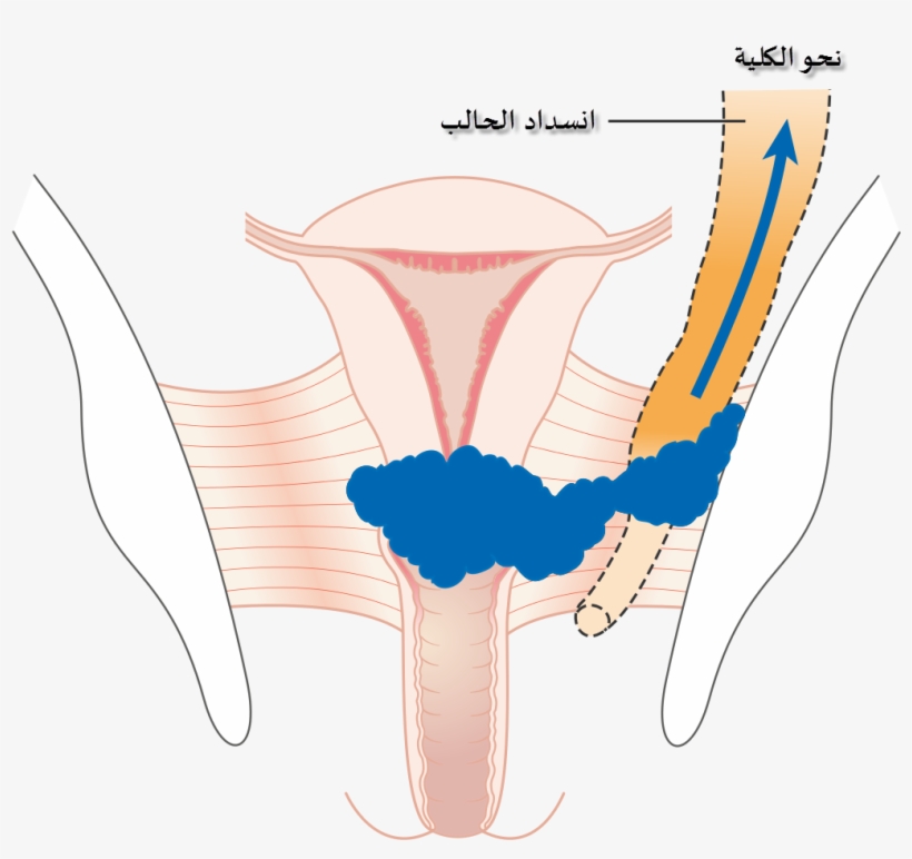 Diagram Showing Stage 3b Cervical Cancer Cruk 226-ar - Stage 3 Cervical Cancer, transparent png download