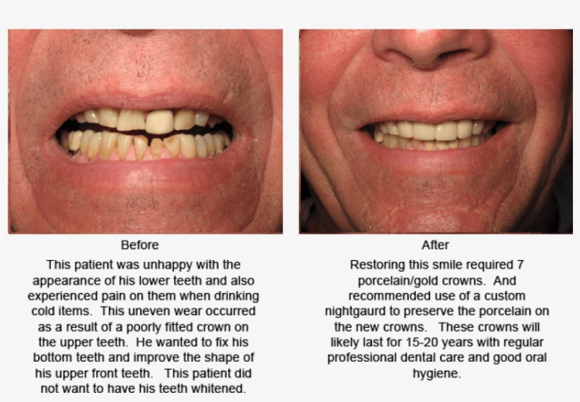 Free Png Download Aggression Png Images Background - Good Teeth Shape, transparent png download