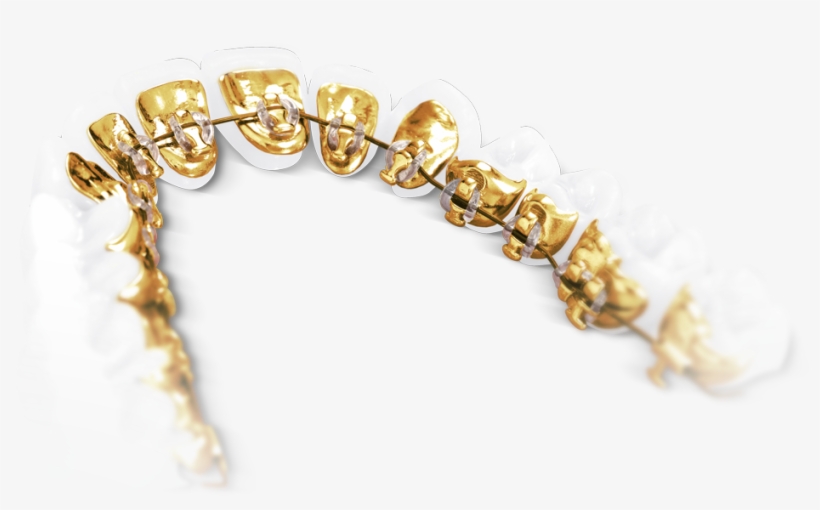 Show Your Teeth But Not Your Braces The Lingual Technique - Incognito Bracket, transparent png download
