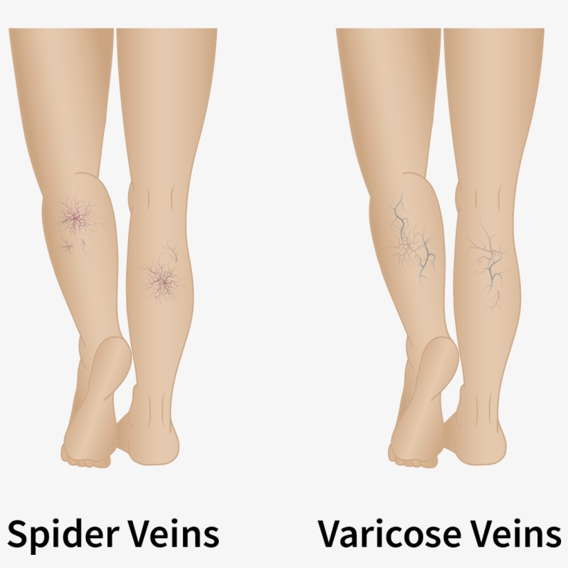 Distinguishing Spider Veins From Varicose Veins - Tights, transparent png download