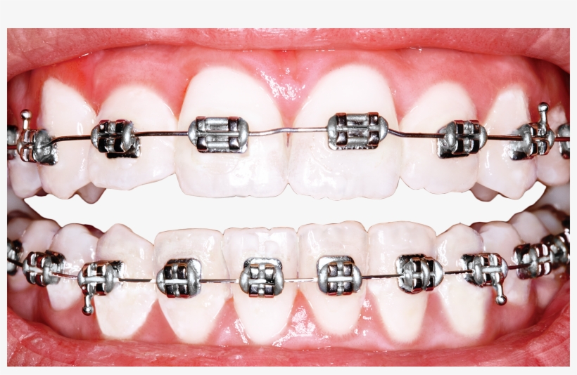 Why Is America Obsessed With Perfect Teeth Science - Braces For Teeth, transparent png download