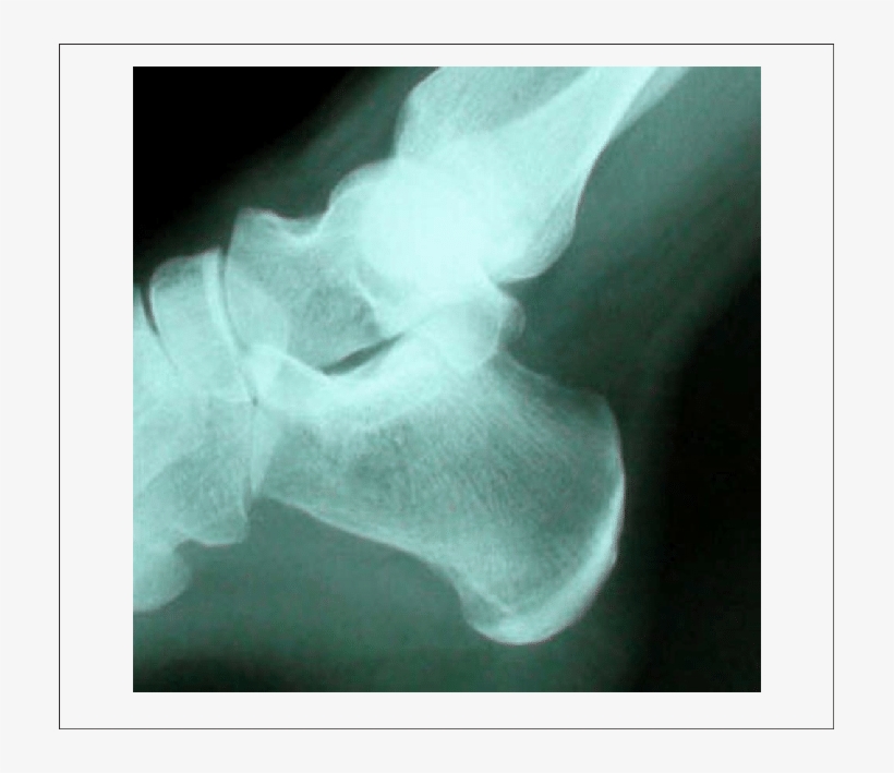 Radiograph Before Shock Wave Therapy - Radiography, transparent png download
