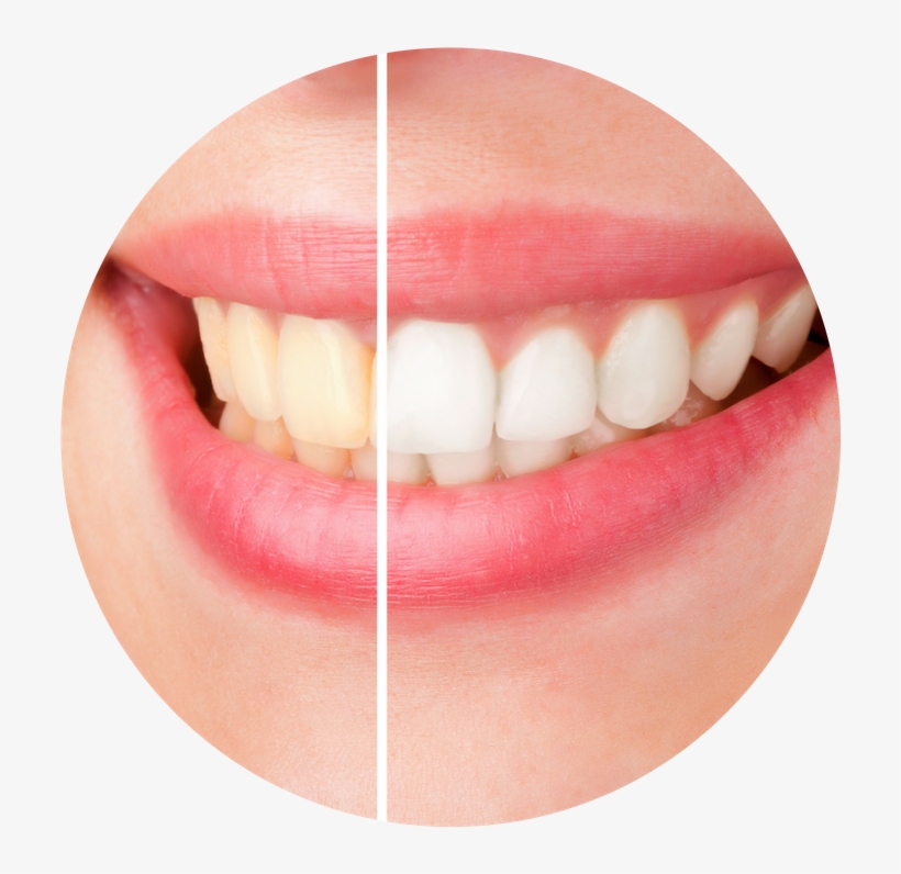 Professional Whitening Products Provide Faster Results - Weiße Zähne Mit Bananenschale, transparent png download