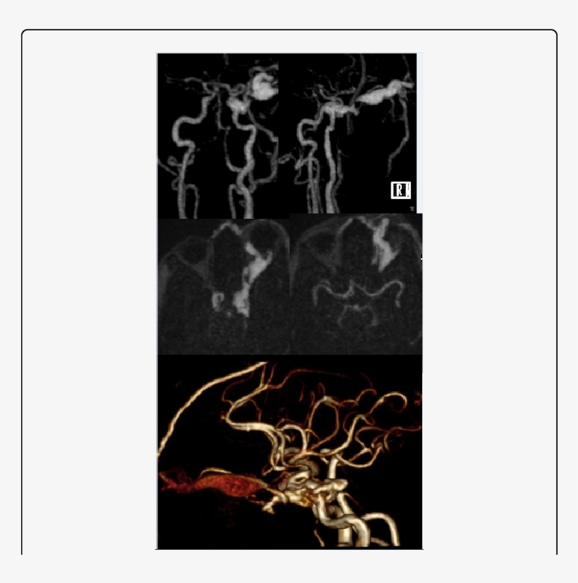 Coronal, Oblique And Axial Postcontrast Mip Images - Skull, transparent png download