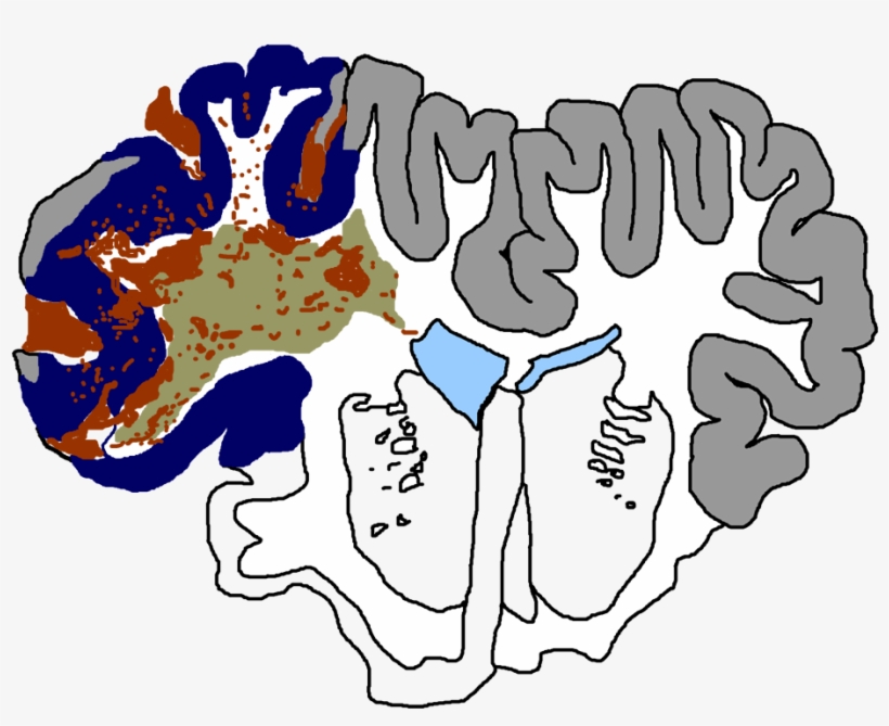 Traumatic Brain Injury Considered The Most Complex - Illustration, transparent png download