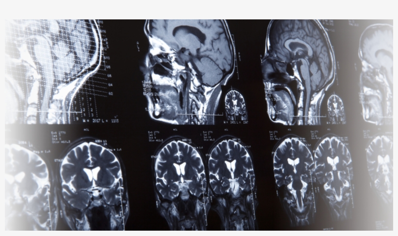 Brain Injuries - Αξονικη Τομογραφια, transparent png download