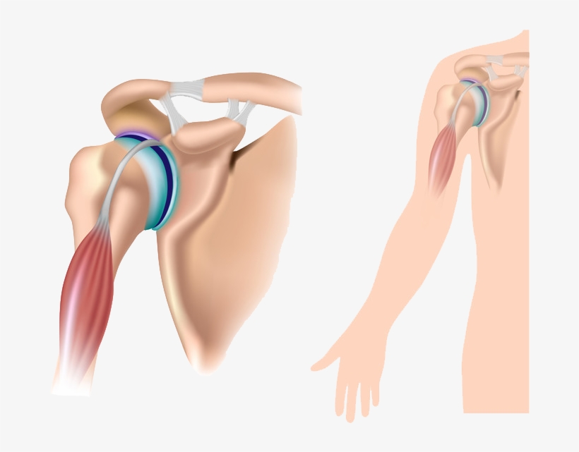 Non-surgical Options - Separated Shoulder, transparent png download