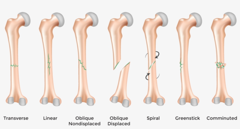 "bone Fracture" - Types Of Bone Fractures In Humans, transparent png download