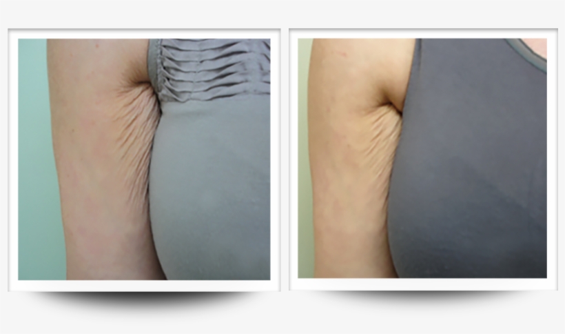 Accent Prime - Flesh, transparent png download