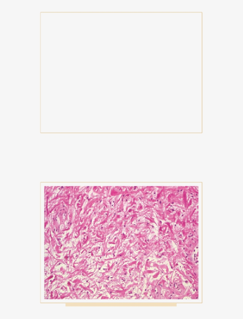 Overview Of Pathology And Treatment Of Primary Spinal - Paper Product, transparent png download