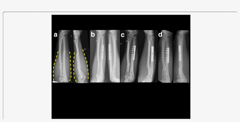 A 35 Year Old Male Sustained A Left Radio Ulnar Shaft - Black-and-white, transparent png download