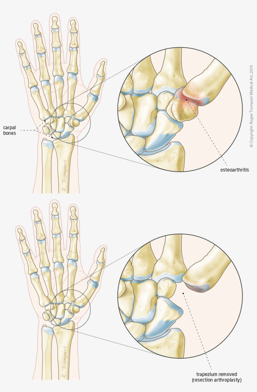 Base Of Thumb Osteoarthritis - Circle, transparent png download