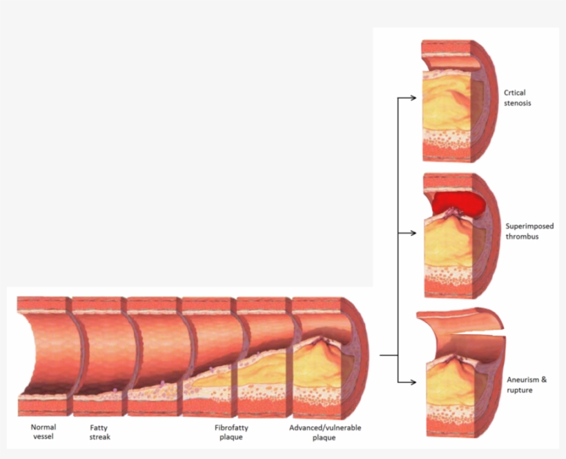 Download Atherosclerosis Png Clipart Atherosclerosis - Atherosclerosis Stenosis, transparent png download
