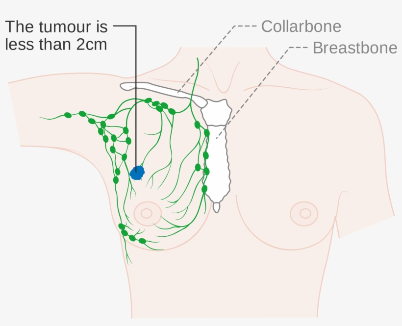 Open - Lymph Nodes On Collar Bones, transparent png download