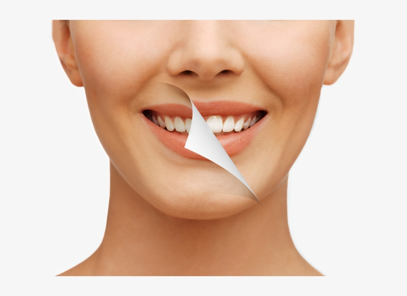 Gold Tooth Price In Cape Town ↺ - חיוך מושלם, transparent png download