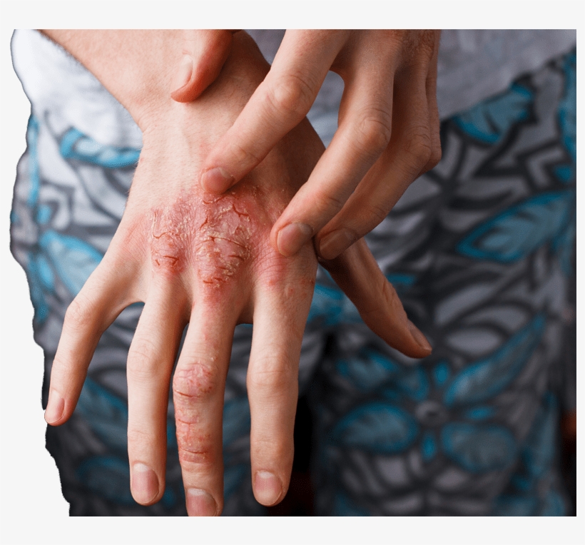 Facial Redness, Rosacea & Spider Veins - Human, transparent png download