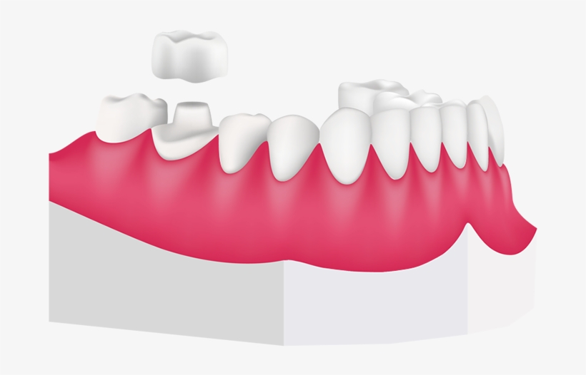 Dental Crowns At Toothbeary, transparent png download