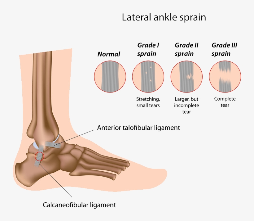 Surgical Options - Sprained Ankle Grade 2, transparent png download