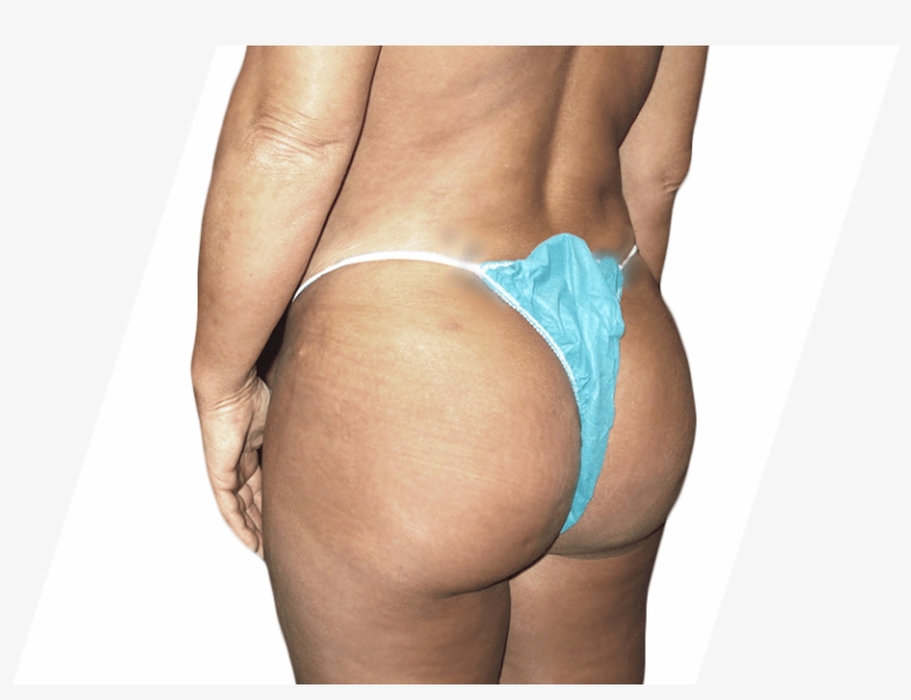 After Brazilian Butt Lift - Brazilian Buttocks, transparent png download
