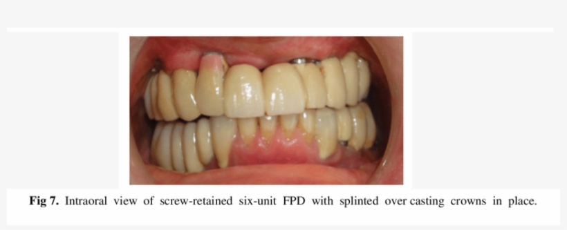 Intraoral View Of Six Unit Screw Retained Fpd Without - Science, transparent png download
