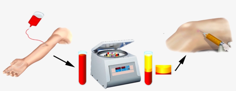 The Platelet-rich Plasma Is Removed From A Vein, Then - Prp Knee, transparent png download
