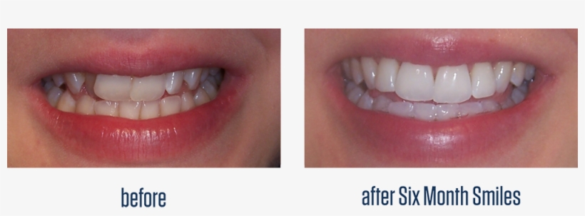 What Is 6 Month Smile® - Tooth Bleaching, transparent png download