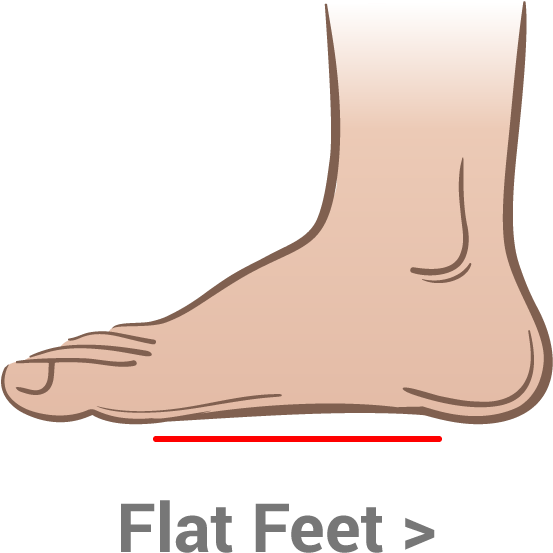 When Your Longitudinal Arch Pronates It Functions Like - Flat Feet (700x700), Png Download