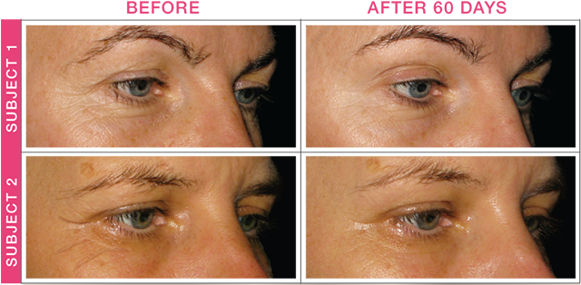 Bottom Line, Subjects Experienced Smoother Skin With - Biosil Effect Before After (639x322), Png Download