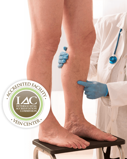 Comprehensive Vein Treatment - Varicose Veins (420x526), Png Download
