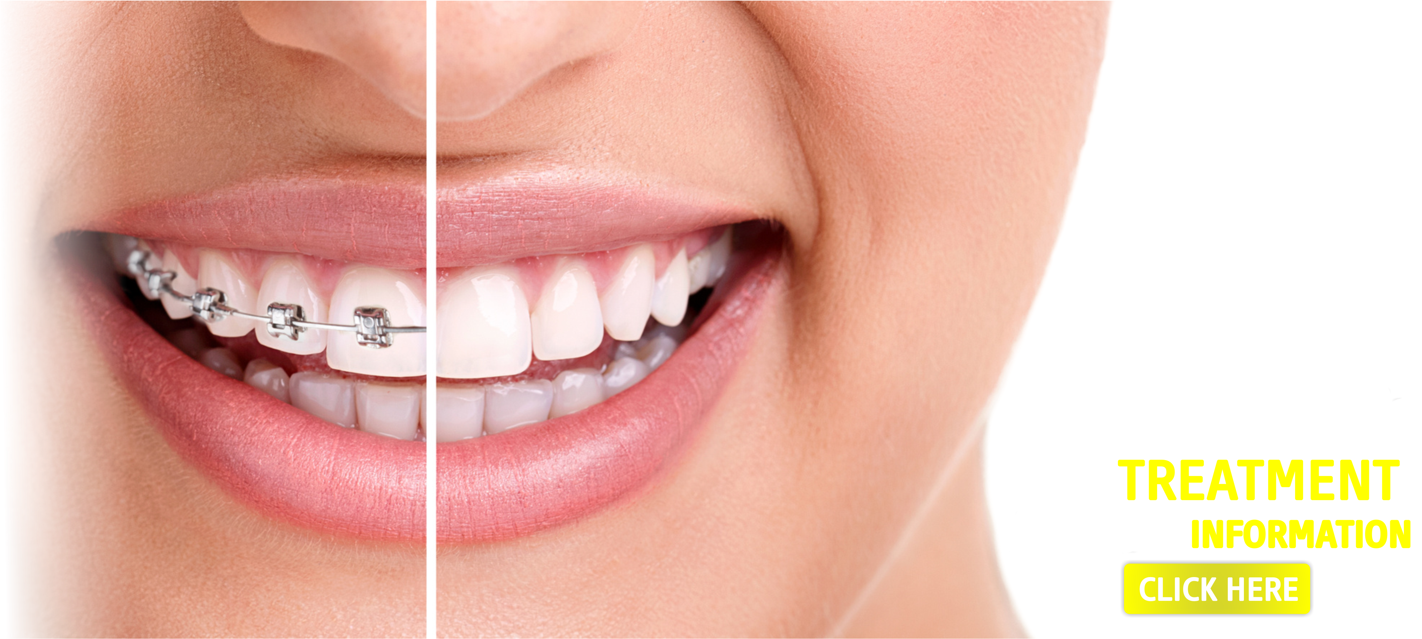Sevgi Dental Clinic, Dental, Dental Clinic, Dentist, - Braces On Vs Off (4633x2074), Png Download