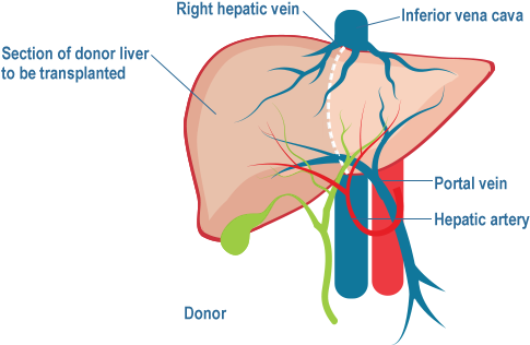 Live Donor Liver Transplantation - Liver Transplantation (784x378), Png Download