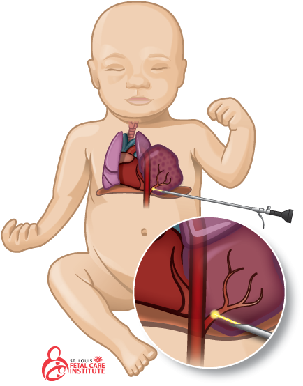 Graphic Of Baby With Bronchopulmonary Sequestration - Bronchopulmonary Sequestration (600x600), Png Download