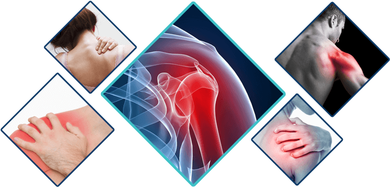 Interactive Body Shoulder Pain - Polymyalgia Rheumatica And Giant Cell Arteritis By (800x400), Png Download