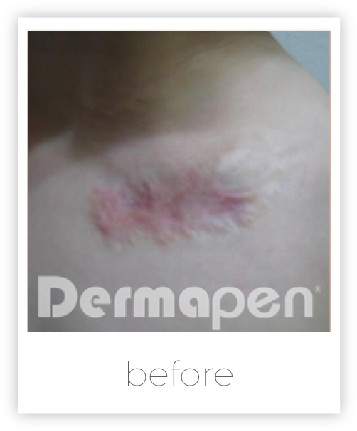 Treat Burn Scars - Harley Cosmetic London (513x618), Png Download